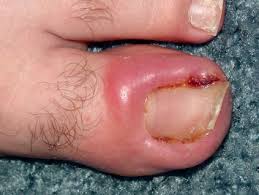 Ingrown Nails